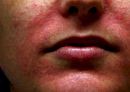 Rosácea, dermatite e outros: os principais cuidados com a pele no inverno para evitar danos