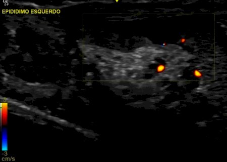 Estudo aponta que Covid afeta testículos e reduz hormônios e qualidade dos espermatozoides