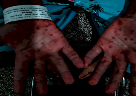 Saúde faz alerta após registrar surto da doença ‘mão-pé-boca’ em MS