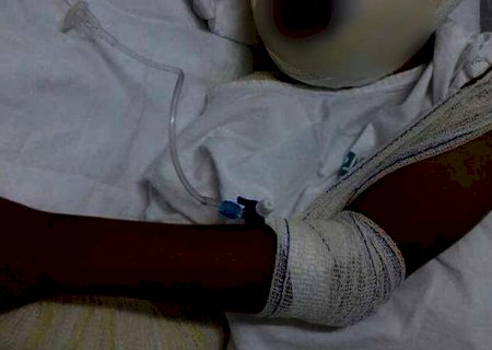 Criança queimada pela mãe ganha atendimento com psicólogo na Santa Casa