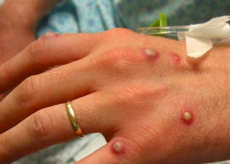 'Não tem por que ela não chegar ao Brasil', diz virologista sobre a varíola do macaco