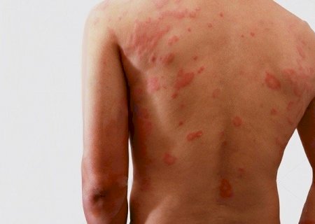 Bioclin produz teste rápido para auxílio no diagnóstico da hanseníase