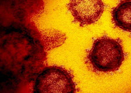 Estudo aponta sequelas neurológicas em pacientes leves de covid-19