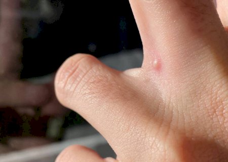 Varíola do macaco: entenda como ocorre a transmissão e saiba o que fazer para se prevenir