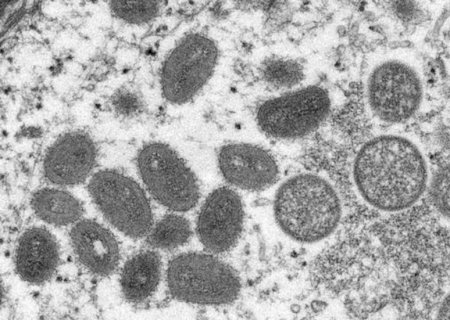 MS tem 61 casos confirmados de varíola dos macacos