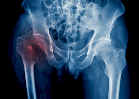 Crescem os casos de fraturas de quadril no mundo, mas h&aacute; formas de prevenir a osteoporose
