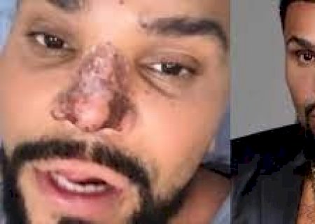 Entenda os riscos da rinomodela&ccedil;&atilde;o, procedimento que causou necrose no nariz do cantor Naldo Benny