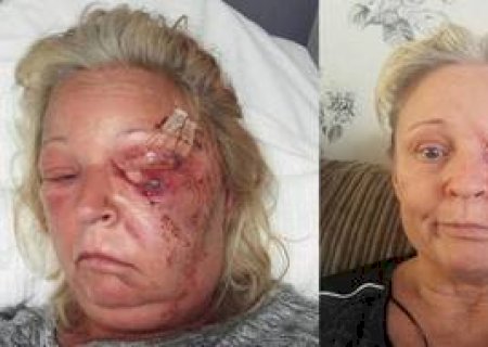 Mulher perde metade do rosto após ser infectada por bactérias devoradoras de carne