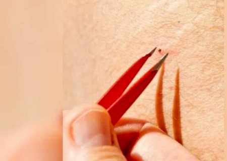 Você sabe quais são os sintomas da febre maculosa? Veja