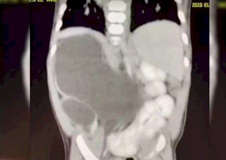 Menina nasce com quatro rins e está entre 100 casos no mundo