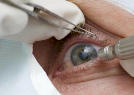 Médicos alertam para riscos de cirurgia de mudança da cor dos olhos