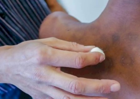 Atenção: Novos casos de hanseníase aumentaram 5% de janeiro a novembro de 2023