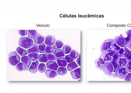 Molécula mostra potencial para combater a leucemia em testes pré-clínicos