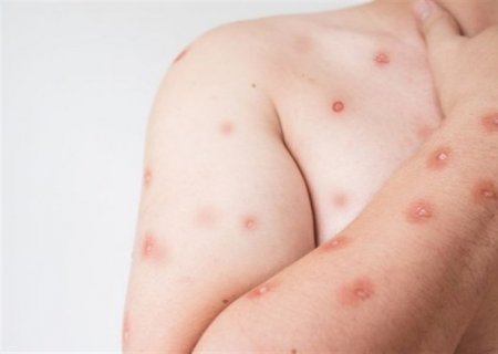 Emergência global por mpox: OMS não aconselha lockdown
