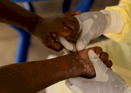 Vacina brasileira contra a mpox está próxima dos testes em humanos