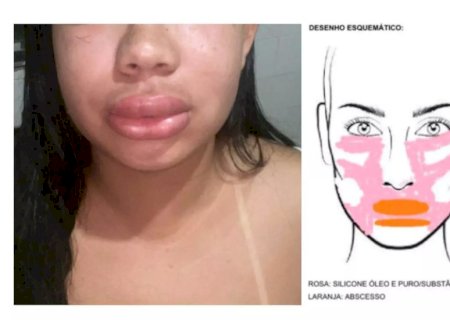 Mulher que teve silicone industrial colocado no rosto por falsa biomédica pede indenização de R$ 100 mil