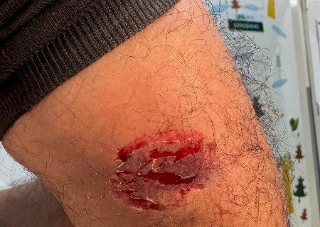 Paciente em surto morde profissional da saúde durante atendimento