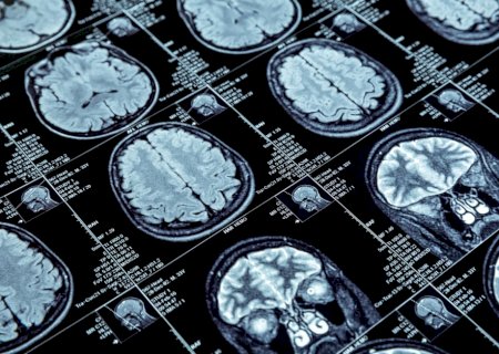 Cinco novidades promissoras no combate ao Alzheimer descobertas em 2025
