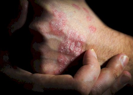 Psoríase afeta autoestima de pacientes e pode gerar inflamação das articulações