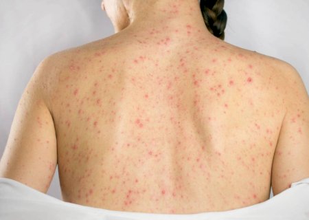 Vírus da catapora pode aumentar o risco de demência, indica estudo