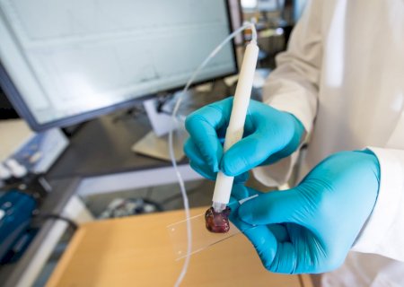 Pesquisadora brasileira cria caneta que detecta câncer em 10 segundos