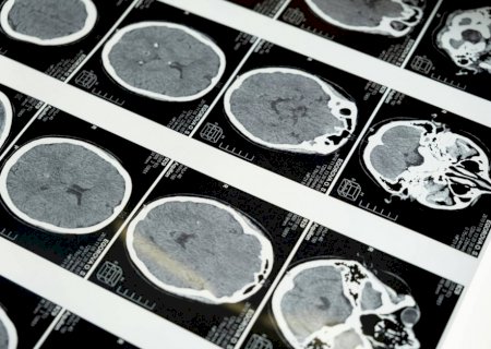 Exame em estudo pode antecipar diagnóstico da esclerose múltipla em 7 anos