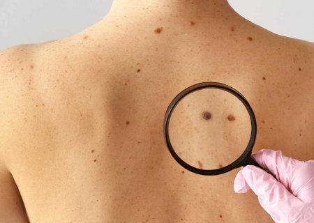 Saiba como se prevenir contra o câncer de pele