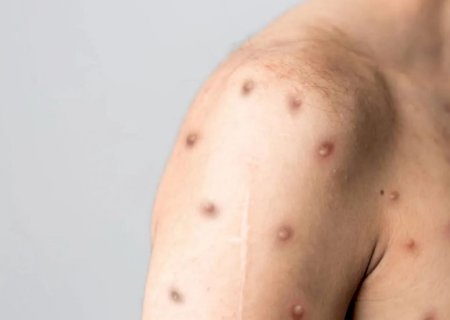 Nova cepa mais perigosa de Mpox é identificada pela segunda vez em São Paulo