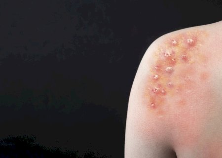 Porto Alegre confirma caso de Mpox