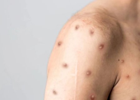 Mpox: a situação atual do surto no Brasil e os estados que lideram em casos