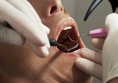 Saliva artificial ajuda a proteger os dentes de pacientes com câncer de cabeça e pescoço