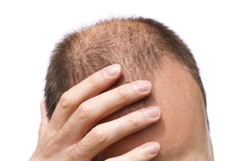Usei a ‘caneta emagrecedora’, perdi peso e quase todo o cabelo