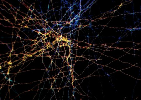 Alzheimer também é doença vascular