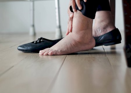 Calor, sedentarismo e dieta rica em sal aumentam inchaço no corpo; saiba como evitar