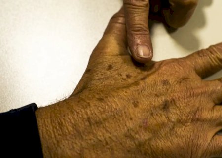Desinformação sobre câncer de pele afeta diagnóstico