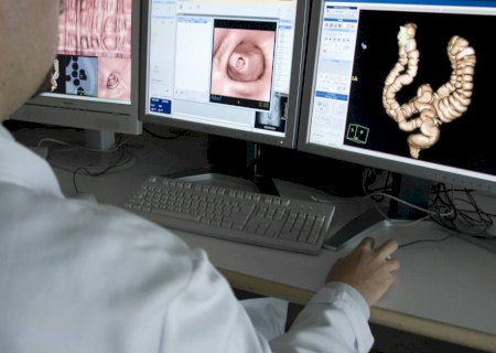 SUS vai incorporar exame mais eficaz para detectar câncer colorretal