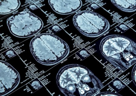 Ainda há esperança no combate contra o Alzheimer: o rigor científico