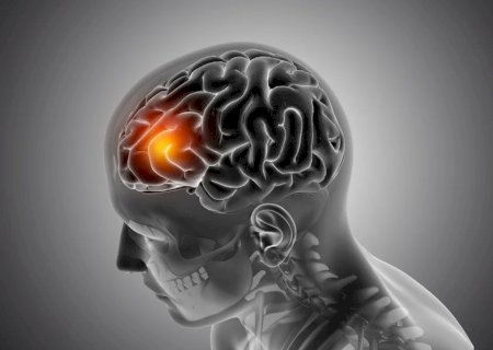 Neurologista revela sinais ‘silenciosos’ do AVC que muita gente ignora