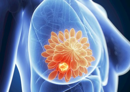 Estudo aponta impactos da dieta, exercícios e vitamina D em pacientes com câncer de mama