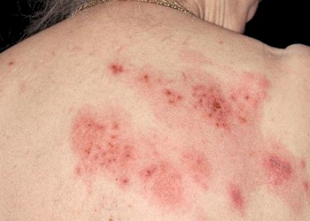 Canetas emagrecedoras e herpes: o alerta que vem de uma nova análise com milhares de usuários