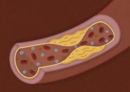 Colesterol alto é sempre culpa da alimentação? Entenda outros fatores