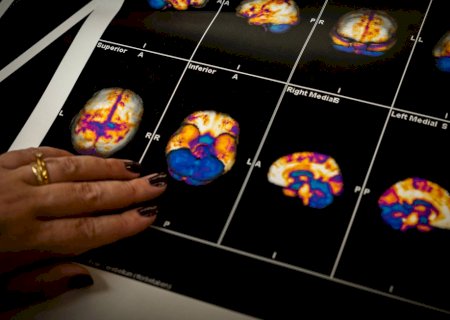 Conheça caso de 'cura' de Alzheimer que correu o mundo