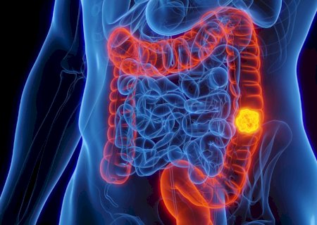 Anvisa aprova novo tratamento para câncer de intestino