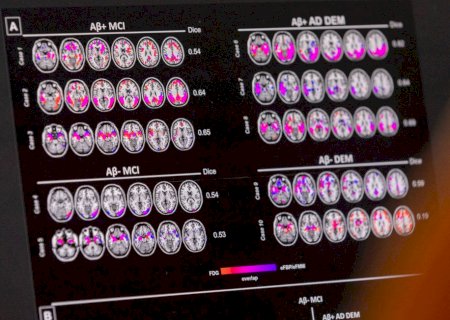 Mudança de hábitos ajuda a diminuir probabilidade de Alzheimer, mesmo com risco genético